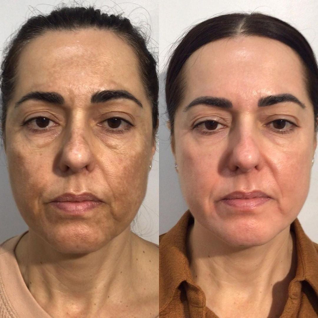 【Dermatologist-Recommended】 VC Spot-Correction & Whitening Cream Set