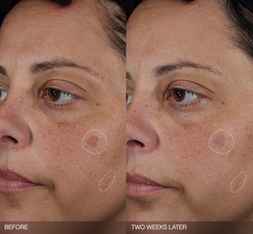 5-Step Advanced Clinical Anti-Spot All-Round Set
